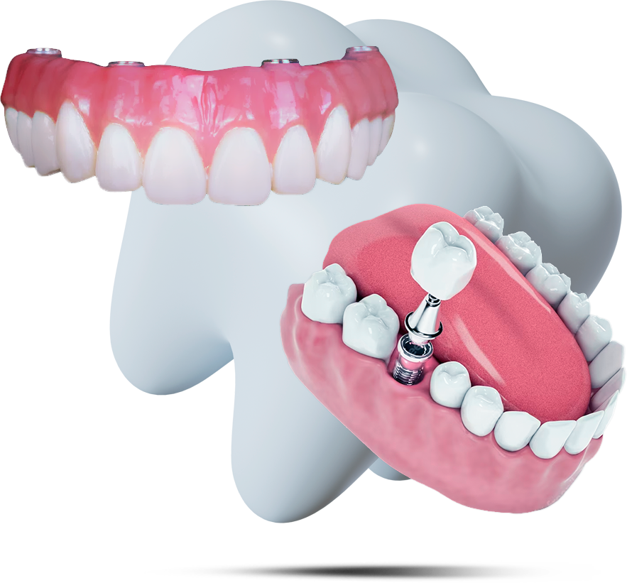 Próteses dentárias de alta precisão - Implantes e protocolos